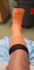 [Bonesmart.org] My total ankle replacement story
