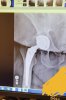 [Bonesmart.org] Brand New Hip