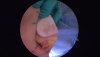 [Bonesmart.org] Left knee patellofemoral arthroplasty