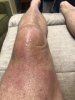 [Bonesmart.org] LTKR April 1 - bending knee hurts