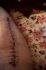 [Bonesmart.org] Hippies scars - post your badges of honor here: NO CHIT-CHAT HERE PLEASE