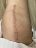 [Bonesmart.org] Knee Scars - Post Your Badges of Honor Here! NO CHIT-CHAT please