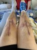 [Bonesmart.org] Bilateral Knee Replacement-Ups and Downs