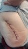 [Bonesmart.org] Hippies scars - post your badges of honor here: NO CHIT-CHAT HERE PLEASE
