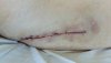 [Bonesmart.org] Hippies scars - post your badges of honor here: NO CHIT-CHAT HERE PLEASE