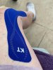 [Bonesmart.org] Bilateral Knee Replacement-Ups and Downs