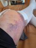 [Bonesmart.org] Knee Scars - Post Your Badges of Honor Here! NO CHIT-CHAT please