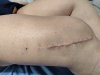[Bonesmart.org] 7 days post-op RTHR