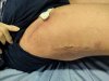 [Bonesmart.org] 7 days post-op RTHR
