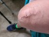 [Bonesmart.org] Knee Scars - Post Your Badges of Honor Here! NO CHIT-CHAT please