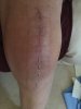 [Bonesmart.org] Knee Scars - Post Your Badges of Honor Here! NO CHIT-CHAT please