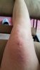 [Bonesmart.org] Knee Scars - Post Your Badges of Honor Here! NO CHIT-CHAT please