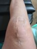 [Bonesmart.org] Struggling to Bend