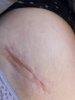 [Bonesmart.org] Hippies scars - post your badges of honor here: NO CHIT-CHAT HERE PLEASE