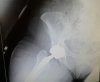 [Bonesmart.org] Right hip done, "Fred" is on board.