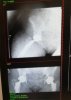 [Bonesmart.org] Right hip done, "Fred" is on board.