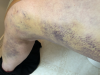 [Bonesmart.org] Susie-Q's 2nd TKR Recovery Thread