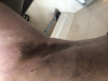 [Bonesmart.org] Susie-Q's 2nd TKR Recovery Thread