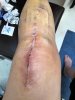 [Bonesmart.org] Susie-Q's 2nd TKR Recovery Thread