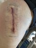 [Bonesmart.org] Hippies scars - post your badges of honor here: NO CHIT-CHAT HERE PLEASE