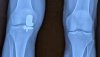 [Bonesmart.org] Long Story of my Battle with a Bad Knee