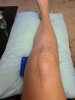 [Bonesmart.org] Struggling to Bend