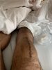 [Bonesmart.org] Knee Scars - Post Your Badges of Honor Here! NO CHIT-CHAT please