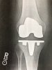 [Bonesmart.org] Knee Wobble Question