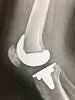 [Bonesmart.org] Knee Wobble Question