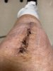 [Bonesmart.org] Knee Scars - Post Your Badges of Honor Here! NO CHIT-CHAT please