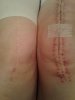 [Bonesmart.org] Knee Scars - Post Your Badges of Honor Here! NO CHIT-CHAT please