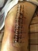 [Bonesmart.org] Knee Scars - Post Your Badges of Honor Here! NO CHIT-CHAT please