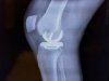 [Bonesmart.org] Knee Wobble Question