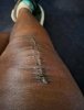 [Bonesmart.org] Knee Scars - Post Your Badges of Honor Here! NO CHIT-CHAT please
