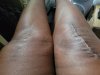 [Bonesmart.org] Knee Scars - Post Your Badges of Honor Here! NO CHIT-CHAT please