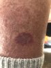 [Bonesmart.org] My TKR Experience