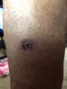 [Bonesmart.org] My TKR Experience