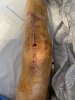 [Bonesmart.org] Knee Scars - Post Your Badges of Honor Here! NO CHIT-CHAT please