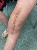 [Bonesmart.org] Knee Scars - Post Your Badges of Honor Here! NO CHIT-CHAT please
