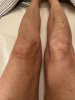 [Bonesmart.org] Knee Scars - Post Your Badges of Honor Here! NO CHIT-CHAT please