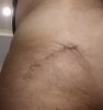 [Bonesmart.org] Hippies scars - post your badges of honor here: NO CHIT-CHAT HERE PLEASE