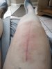 [Bonesmart.org] Knee Scars - Post Your Badges of Honor Here! NO CHIT-CHAT please