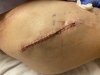 [Bonesmart.org] Hippies scars - post your badges of honor here: NO CHIT-CHAT HERE PLEASE