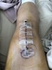 [Bonesmart.org] Knee Scars - Post Your Badges of Honor Here! NO CHIT-CHAT please