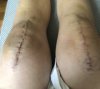 [Bonesmart.org] Knee Scars - Post Your Badges of Honor Here! NO CHIT-CHAT please