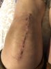 [Bonesmart.org] Knee Scars - Post Your Badges of Honor Here! NO CHIT-CHAT please