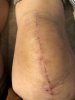 [Bonesmart.org] Knee Scars - Post Your Badges of Honor Here! NO CHIT-CHAT please