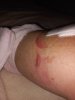 [Bonesmart.org] 2nd knee, 2nd recovery
