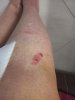 [Bonesmart.org] 2nd knee, 2nd recovery