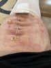 [Bonesmart.org] 2nd knee, 2nd recovery